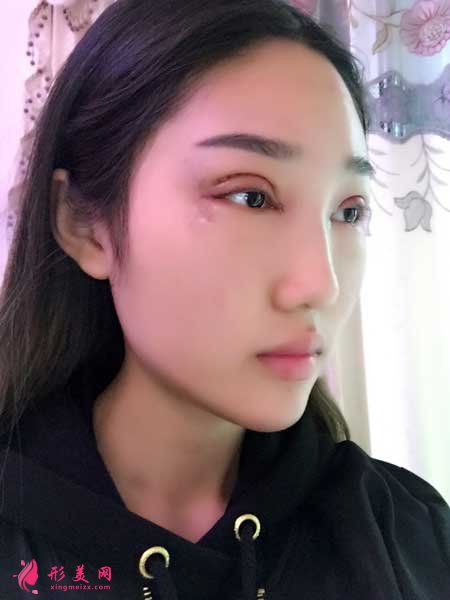 雙眼皮修復(fù)手術(shù)前