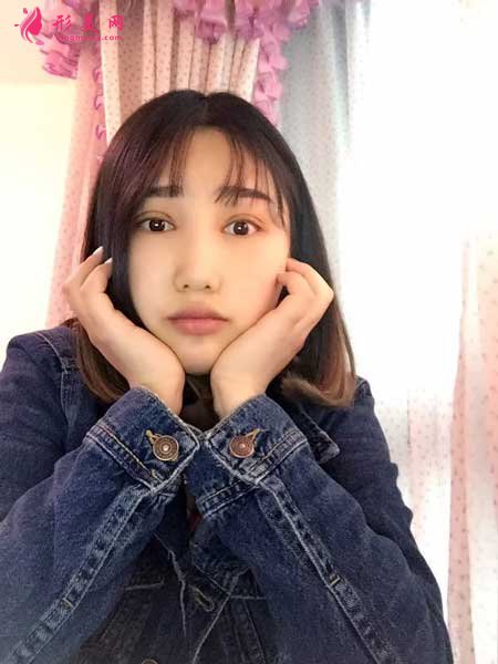 雙眼皮修復(fù)術(shù)后第1天