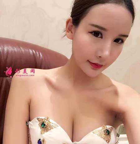 自體脂肪面部填充術(shù)后25天