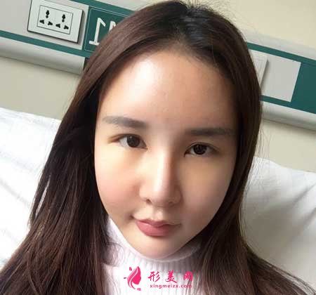 自體脂肪面部填充術(shù)后10天