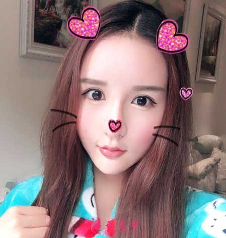 自體脂肪面部填充術(shù)后40天