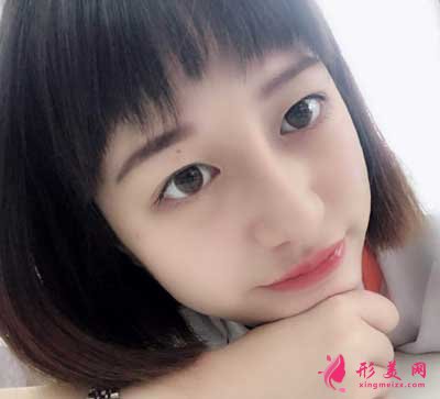 鼻綜合整形術后18天