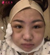重慶時(shí)光做的下頜角+顴骨顴弓手術(shù)，我也是精致小臉了