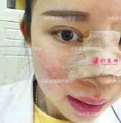 成都素美做的膨體鼻綜合隆鼻手術(shù)，真的是美炸了