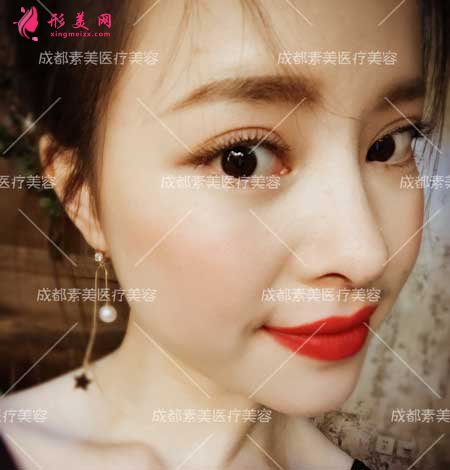 膨體鼻綜合隆鼻手術(shù)后65天