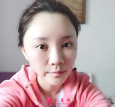 自體脂肪面部填充術(shù)后5天
