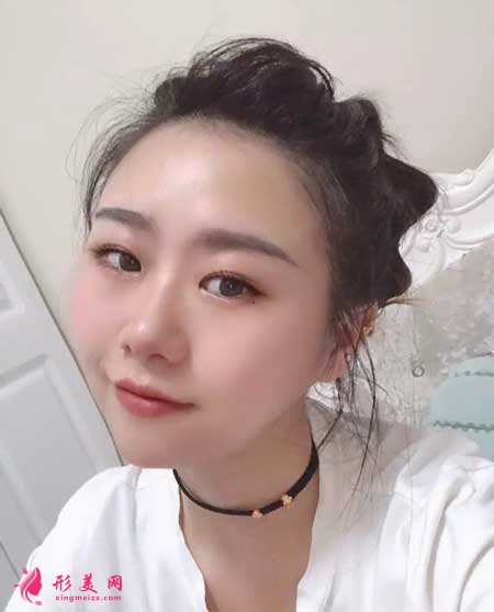 熱拉提手術后30天