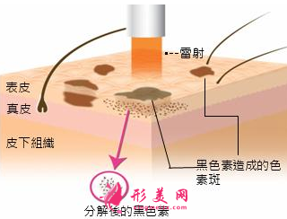孕期可以做激光祛黃褐斑嗎