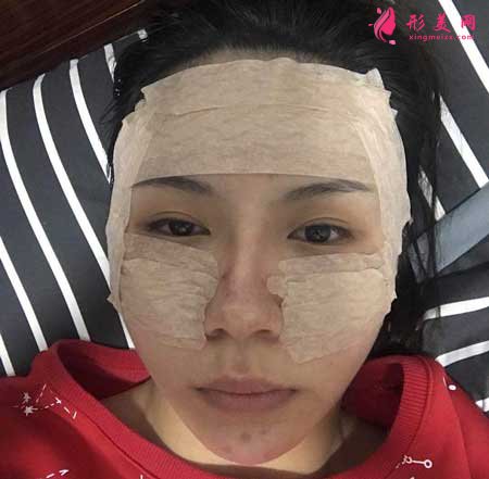 自體脂肪面部填充手術后