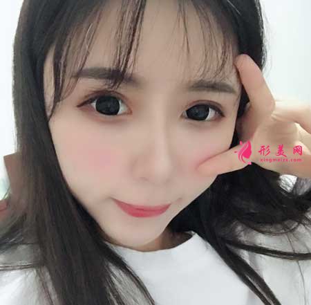 自體脂肪面部填充手術后45天