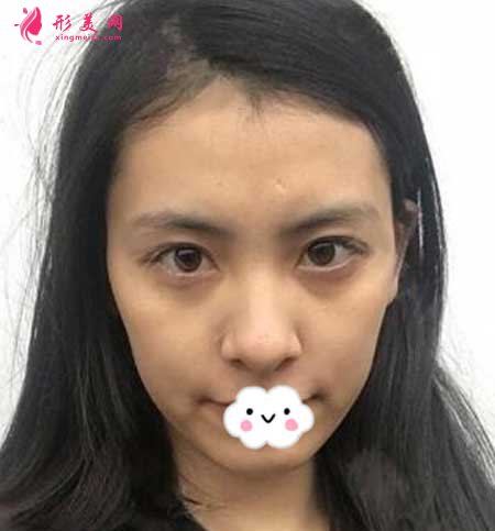 重慶華美李瑞琦做埋線提升手術(shù)案例