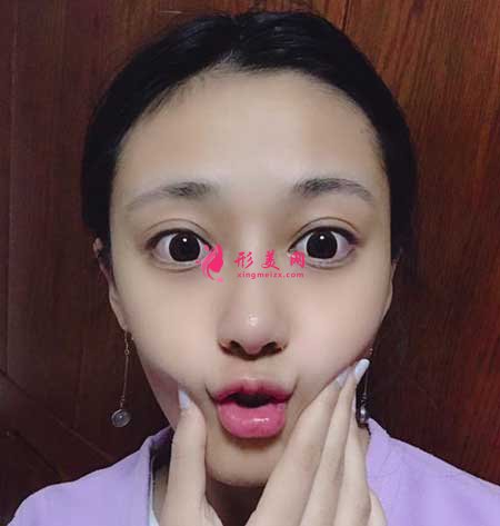 自體肋軟骨隆鼻術(shù)后20天
