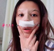成都軍大做的自體肋軟骨隆鼻，終于讓我圓夢(mèng)了小翹鼻