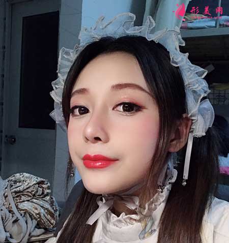 自體肋軟骨隆鼻術(shù)后10天