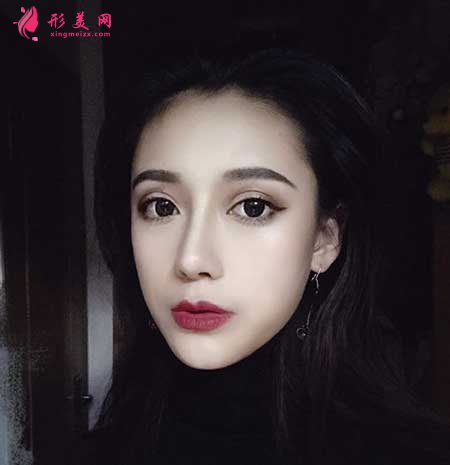 自體肋軟骨隆鼻術(shù)后一個(gè)月