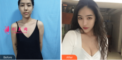 北京葉子整形醫(yī)院隆胸案例，效果真的很不錯