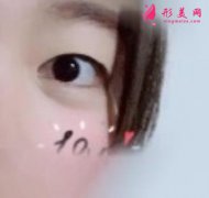 鄭州大學(xué)附屬鄭州中心醫(yī)院割雙眼皮案例，直觀感受術(shù)后效果