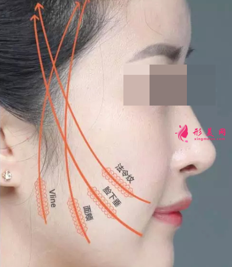 面部埋線提升可以保持多久