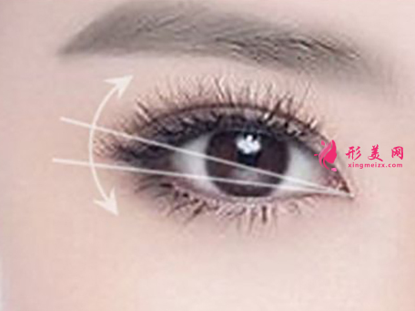 開內(nèi)眼角手術的效果好嗎