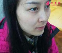北京八大處楊明勇做雙眼皮案例！說說做眼睛整形的心理感受！