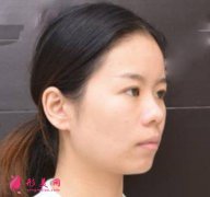 廣州韓妃隆鼻整形案例實拍圖，六個月前后對比變化大