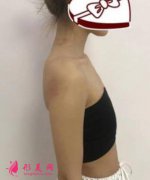 上海九院曹衛(wèi)剛抽脂隆胸怎么樣？真人案例一覽