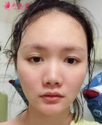 河北省三院整形科價(jià)格表收費(fèi)趨勢(shì)&隆鼻案例效果圖反饋給大家