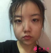 廣州廣大下頜角整形案例及價(jià)格表明細(xì)一覽！
