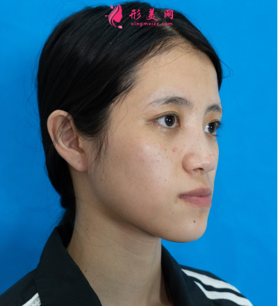 武漢美亞金國華面部脂肪填充 武漢美亞金國華面部脂肪填充