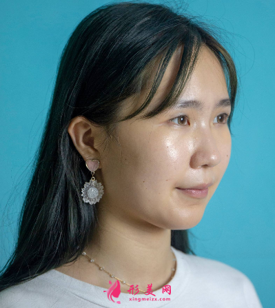 武漢美亞整形醫(yī)院劉佳亮雙眼皮 武漢美亞整形醫(yī)院劉佳亮雙眼皮