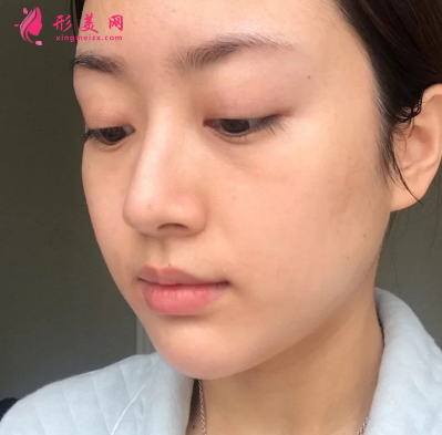 武漢美亞整形醫(yī)院謝大明面部除皺