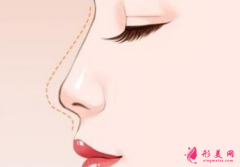 自體軟骨隆鼻的費用受什么影響？
