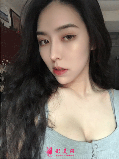 北京葉子整形醫(yī)院魯禮新隆胸 隆胸一個(gè)月后