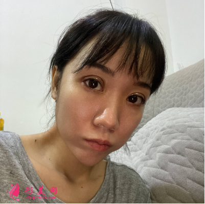 深圳福華整形醫(yī)院李敏雙眼皮