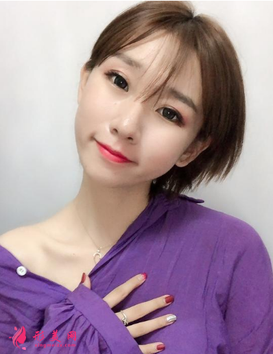 深圳銘醫(yī)劉昕做雙眼皮