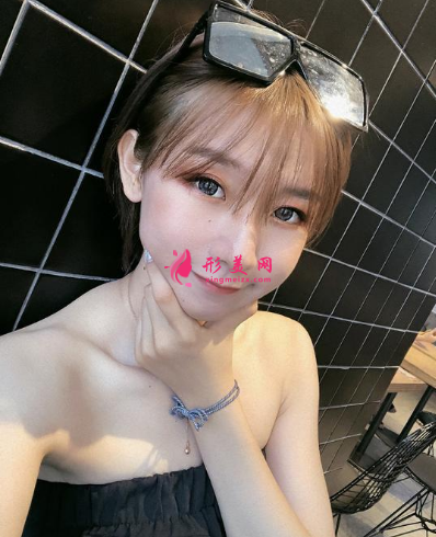 深圳銘醫(yī)劉昕做雙眼皮