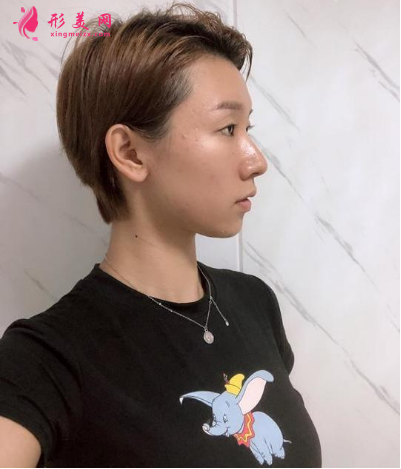 深圳銘醫(yī)劉昕做雙眼皮