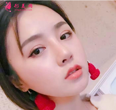 雙眼皮