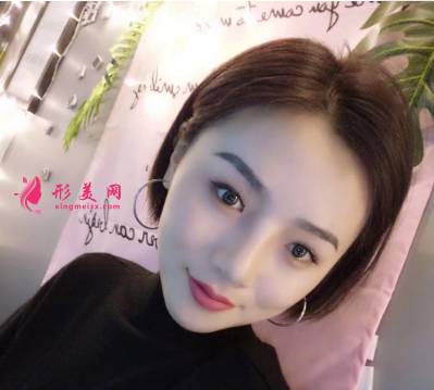 雙眼皮整形