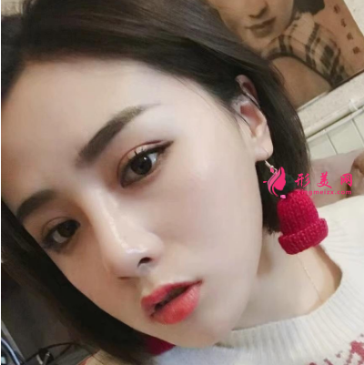 雙眼皮