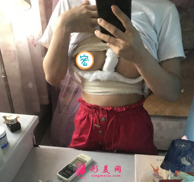 北京葉子整形醫(yī)院楊峰假體隆胸