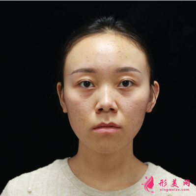 北京圣嘉新整形醫(yī)院康華去痘坑