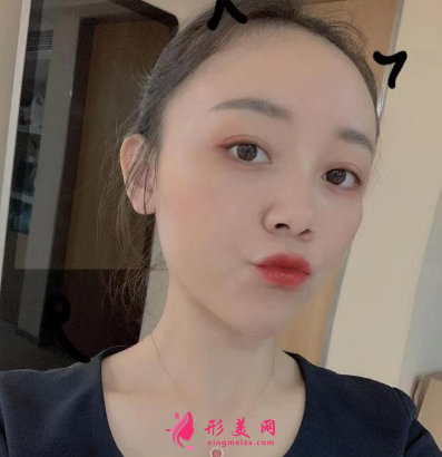北京圣嘉新整形醫(yī)院康華去痘坑