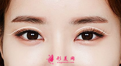 做雙眼皮選擇怎樣的醫(yī)生比較好