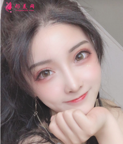雙眼皮整形