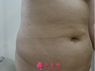 深圳非凡王天成腰部吸脂 深圳非凡王天成腰部吸脂