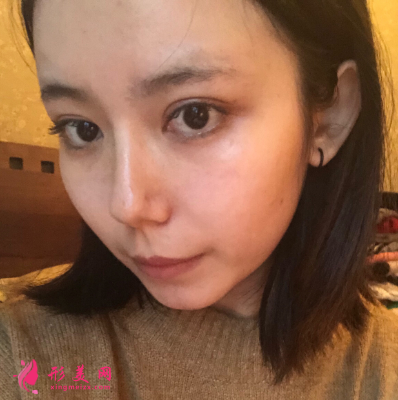 深圳非凡整形醫(yī)院梅夠明隆鼻手術(shù) 深圳非凡整形醫(yī)院梅夠明隆鼻手術(shù)