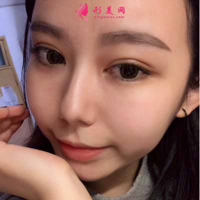 深圳非凡整形醫(yī)院梅夠明隆鼻手術(shù) 深圳非凡整形醫(yī)院梅夠明隆鼻手術(shù)