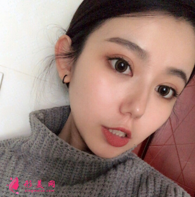 深圳非凡整形醫(yī)院梅夠明隆鼻手術(shù) 深圳非凡整形醫(yī)院梅夠明隆鼻手術(shù)