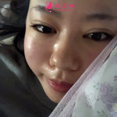 深圳非凡整形醫(yī)院梅夠明隆鼻手術(shù) 深圳非凡整形醫(yī)院梅夠明隆鼻手術(shù)
